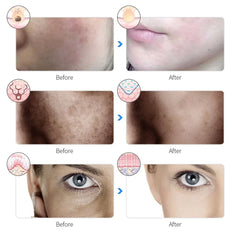 NNEOBA 7-Color LED Photon Therapy Rechargeable Facial Mask - Skin Rejuvenation & Beauty Device-4